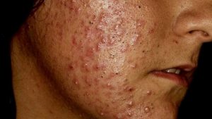 traitement de l'acné comédonique buenos aires