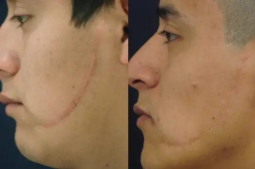 remove scars with laser