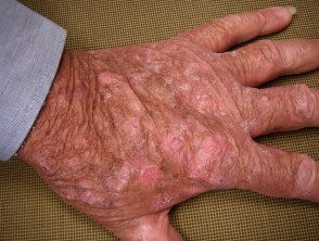 Queratosis actínicas que afectan las manos.