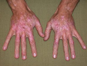 Queratosis actínicas que afectan las manos.