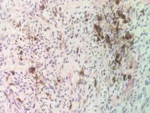 combined-cellular-blue-naevus-and-trichoepithelioma-figure-4__protectwyjqcm90zwn0il0_focusfillwzi5ncwymjisinkildewxq-3326299-5750377