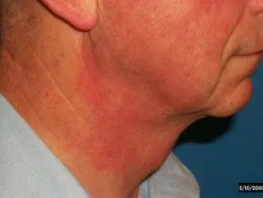 Alergia de contacto a la fragancia después del afeitado