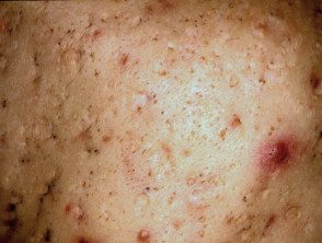 Cicatrices de acné con picahielo