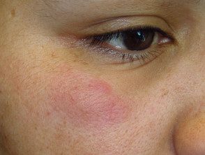 Tupido crónico de lupus eritematoso
