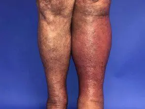 Celulitis de la pierna izquierda.