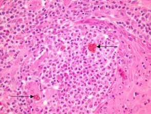 chromoblastomycose-figure-4__protectwyjqcm90zwn0il0_focusfillwzi5ncwymjisingildfd-7811471-1797388
