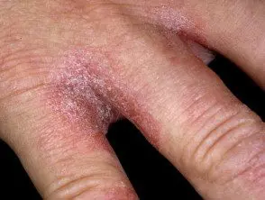 Dermatitis de manos por exposición excesiva al agua.