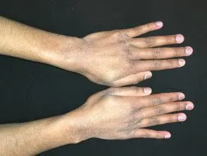 Dermatitis de contacto por lavado de manos.