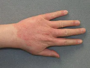 Dermatitis de contacto por lavado