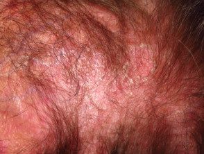 Dermatomiositis del cuero cabelludo.