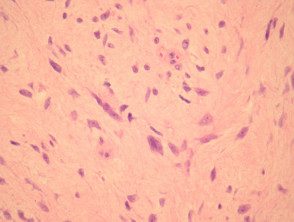 giant-cell-fibroblastoma-fig-2__protectwyjqcm90zwn0il0_focusfillwzi5ncwymjisingildfd-1541029-5405777