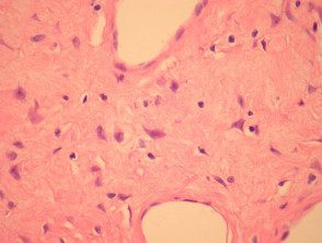 giant-cell-fibroblastoma-fig-3__protectwyjqcm90zwn0il0_focusfillwzi5ncwymjisingildfd-9801716-1467040