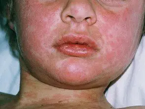 measles11__protectwyjqcm90zwn0il0_focusfillwzi5ncwymjisingildfd-9319053-5544391