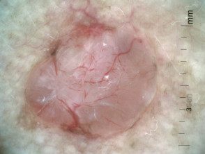 Carcinoma de células basales nodulares 3 dermatoscópico