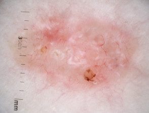 Dermatoscopia de carcinoma nodular de células basales