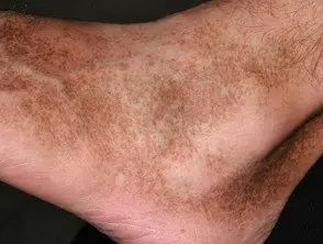 Dermatitis purpúrica pigmentada