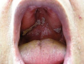 Tabaquismo y candidiasis oral