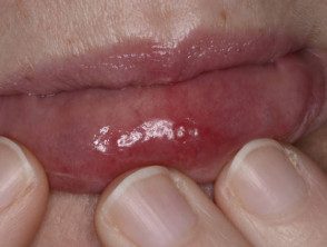 Síndrome dulce que afecta el labio