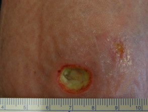 Úlcera reumatoide