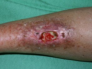Necrobiosis lipoídica ulcerada