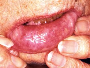 Ulceración labial por granulomatosis con poliangitis