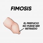 fimosis