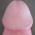 papules de pénis perle