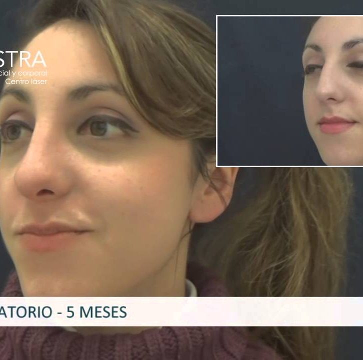 [:es]Tipos De Rinoplastia - Con Y Sin Cirugía - Hoogstra Buenos Aires[:]