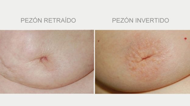 pezon retraido umbilicado