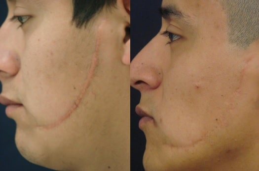 remover cicatrizes com laser