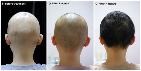 tratamiento laser alopecia