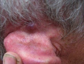 Carcinoma basocelular que afecta el oído