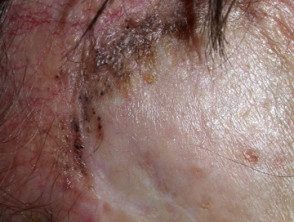 Carcinoma basocelular que afecta la cara