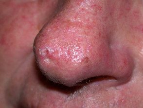 Carcinoma basocelular que afecta la nariz