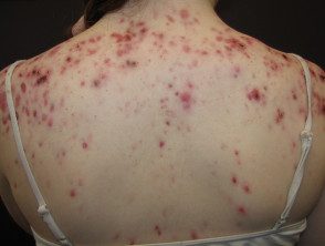 Gestion de l'acné - Hoogstra - Centres médicaux