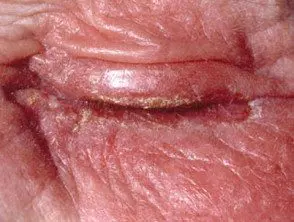 Dermatitis alérgica de contacto en el párpado