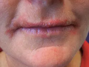 Dermatitis alérgica de contacto en los labios.