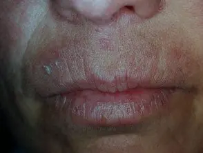 Dermatitis alérgica de contacto alrededor de los labios.