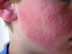 Imágenes De Dermatitis Alérgica De Contacto De La Cara - Hoogstra ...