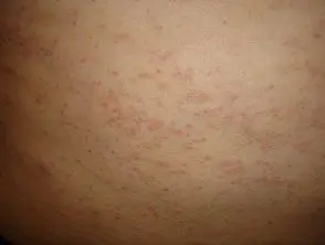 Dermatitis alérgica de contacto del torso 