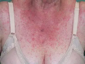 Dermatitis alérgica de contacto del torso 