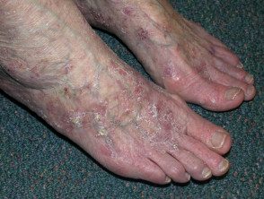 Queratosis actínicas que afectan las piernas y los pies.