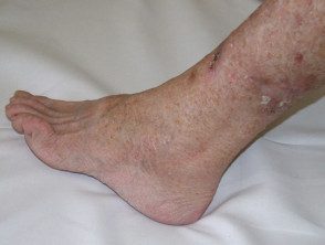 Queratosis actínicas que afectan las piernas y los pies. 