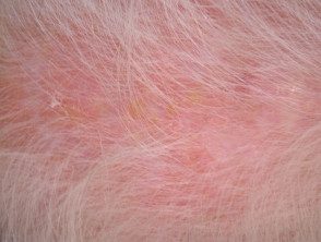 Queratosis actínicas que afectan el cuero cabelludo