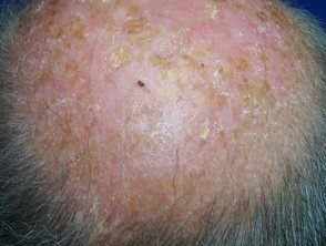 Queratosis actínicas que afectan el cuero cabelludo