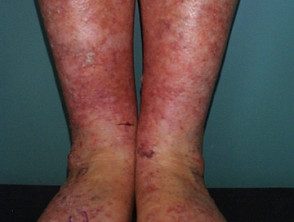 Queratosis actínicas que afectan las piernas y los pies. 