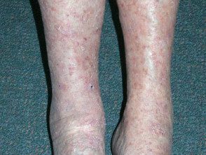 Queratosis actínicas que afectan las piernas y los pies.