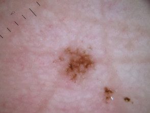 Dermatoscopia del melanoma lentiginoso acral