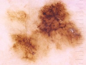 Líneas anguladas vistas en la dermatoscopia de un melanoma