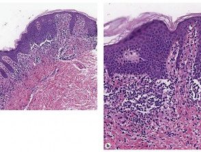 annular-lichenoid-dermatitis-fig-2-histopathogical-features__protectwyjqcm90zwn0il0_focusfillwzi5ncwymjisingildy2xq-8383596-4366175